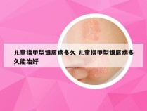 儿童指甲型银屑病多久 儿童指甲型银屑病多久能治好