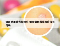 银屑病用激光有效吗 银屑病用激光治疗仪有用吗
