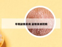 早期副银屑病 副银屑病初期