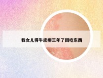 我女儿得牛皮癣三年了因吃东西