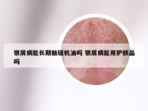 银屑病能长期触碰机油吗 银屑病能用护肤品吗