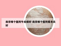 南京哪个医院牛皮癣好 南京哪个医院看鼻炎好