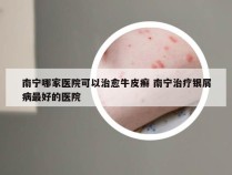 南宁哪家医院可以治愈牛皮癣 南宁治疗银屑病最好的医院