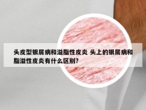 头皮型银屑病和溢脂性皮炎 头上的银屑病和脂溢性皮炎有什么区别?