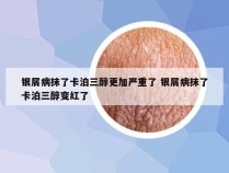 银屑病抹了卡泊三醇更加严重了 银屑病抹了卡泊三醇变红了