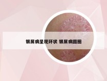 银屑病呈现环状 银屑病圆圈