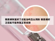 银屑病恢复好了还能治吗怎么预防 银屑病好之后能不能恢复正常皮肤