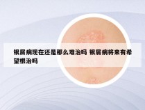 银屑病现在还是那么难治吗 银屑病将来有希望根治吗