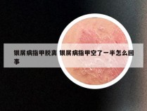 银屑病指甲脱离 银屑病指甲空了一半怎么回事