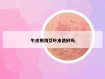 牛皮癣用艾叶水洗好吗
