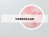 牛皮癣应该怎么治啊