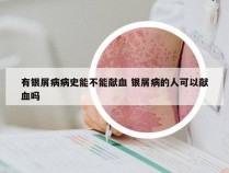 有银屑病病史能不能献血 银屑病的人可以献血吗