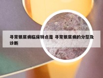 寻常银屑病临床特点是 寻常银屑病的分型及诊断