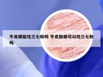 牛皮癣能吃三七粉吗 牛皮肤癣可以吃三七粉吗