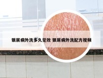 银屑病外洗多久见效 银屑病外洗配方视频