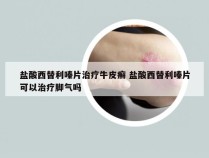 盐酸西替利嗪片治疗牛皮癣 盐酸西替利嗪片可以治疗脚气吗