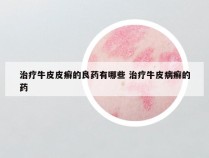 治疗牛皮皮癣的良药有哪些 治疗牛皮病癣的药