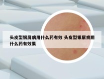 头皮型银屑病用什么药有效 头皮型银屑病用什么药有效果