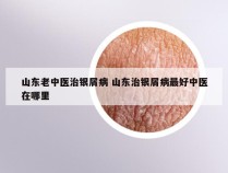 山东老中医治银屑病 山东治银屑病最好中医在哪里