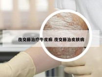夜交藤治疗牛皮癣 夜交藤治皮肤病