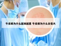 牛皮癣为什么越来越重 牛皮癣为什么会变大