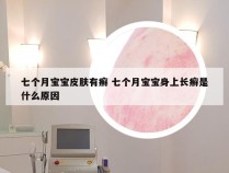 七个月宝宝皮肤有癣 七个月宝宝身上长癣是什么原因