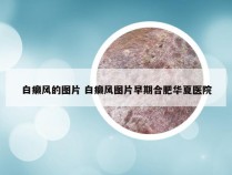 白癞风的图片 白癞风图片早期合肥华夏医院