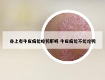 身上有牛皮癣能吃鸭肝吗 牛皮癣能不能吃鸭