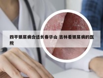 四平银屑病合适长春华山 吉林看银屑病的医院