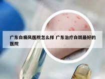 广东白癜风医院怎么样 广东治疗白斑最好的医院