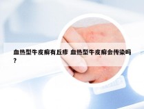 血热型牛皮癣有丘疹 血热型牛皮癣会传染吗?