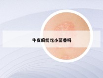 牛皮癣能吃小茴香吗