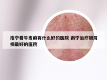 南宁看牛皮癣有什么好的医院 南宁治疗银屑病最好的医院
