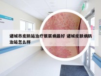 诸城市皮防站治疗银屑病最好 诸城皮肤病防治站怎么样