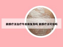 截根疗法治疗牛皮癣复发吗 截根疗法可信吗
