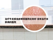 治疗牛皮癣吉林哪家医院比较好 吉林治疗皮肤病的医院