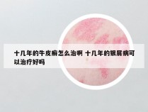 十几年的牛皮癣怎么治啊 十几年的银屑病可以治疗好吗