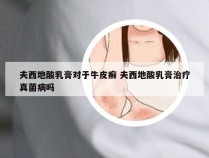 夫西地酸乳膏对于牛皮癣 夫西地酸乳膏治疗真菌病吗