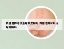 白醋泡脚可以治疗牛皮癣吗 白醋泡脚可以治疗脚癣吗