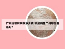 广州治银屑病病多少钱 银屑病在广州哪里看最好?