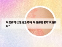 牛皮癣可以泡浴治疗吗 牛皮癣患者可以泡脚吗?