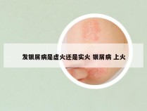 发银屑病是虚火还是实火 银屑病 上火