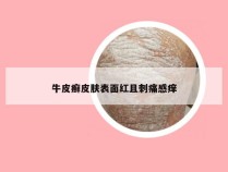 牛皮癣皮肤表面红且刺痛感痒