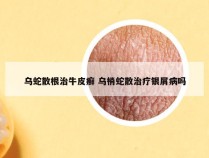 乌蛇散根治牛皮癣 乌梢蛇散治疗银屑病吗