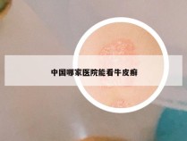 中国哪家医院能看牛皮癣