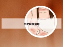 牛皮癣皮加厚