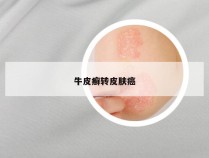 牛皮癣转皮肤癌