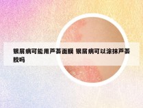 银屑病可能用芦荟面膜 银屑病可以涂抹芦荟胶吗