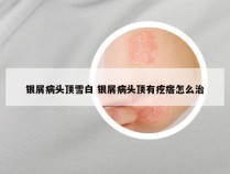 银屑病头顶雪白 银屑病头顶有疙瘩怎么治