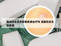 脂溢性皮炎按照银屑病治疗吗 溢脂性皮炎 银屑病